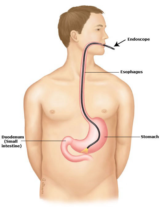 Colonoscopy